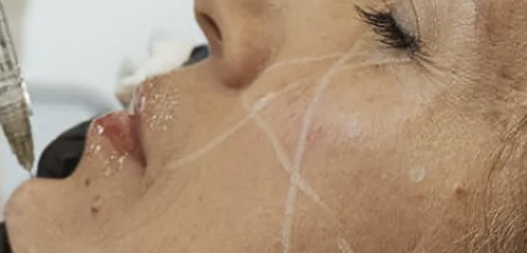Máster en Medicina Estética con énfasis en Toxina Botulínica, Aumento de los Tejidos Blandos y Cosmecéuticos